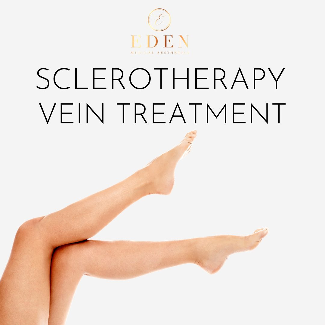 Thread Vein Removal